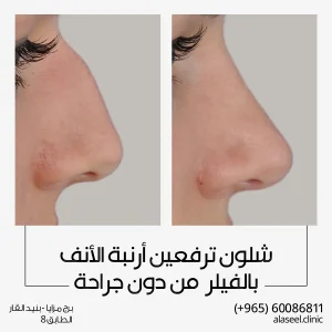 علاج ارنبه الانف بالفيلر