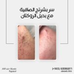 بديل الروكتان لعلاج الحبوب