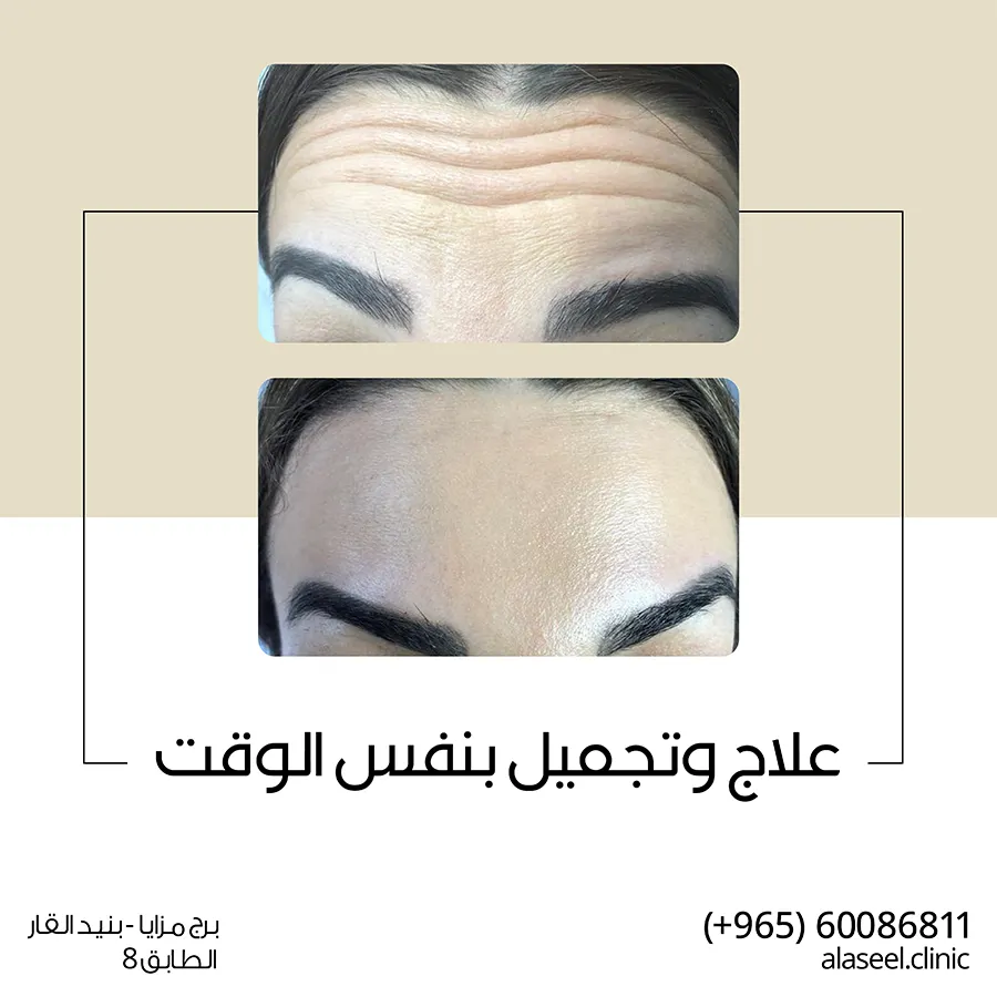 بوتكس وتجميل في نفس الوقت