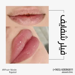 فيلر الشفايف