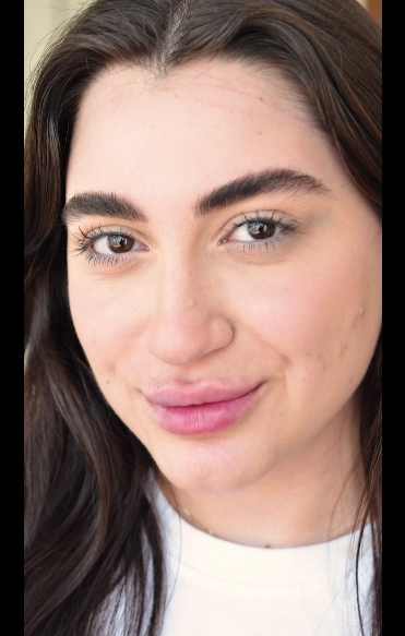 فيلر الشفايف